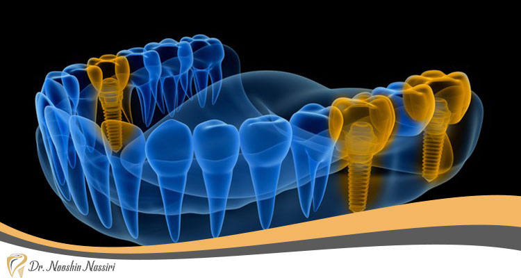 تصویر برداری داخل دهان در دندانپزشکی دیجیتال