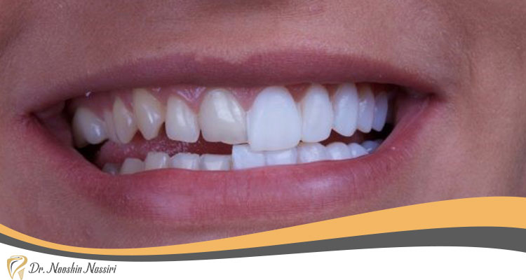 تفاوت دندان های روکش شده با کامپوزیت ونیر با دندان های طبیعی