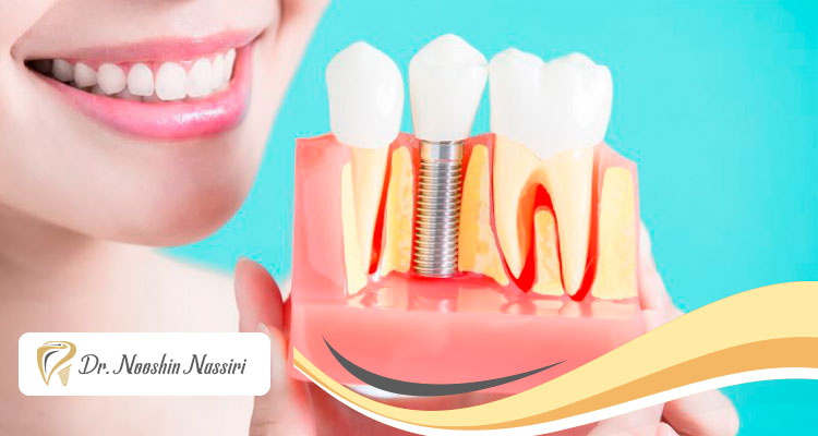 روش های متفاوت کاشت ایمپلنت دندان