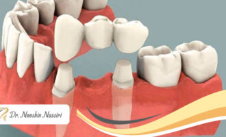 جایگزینی دندان از دست رفته بدون ایمپلنت با استفاده از بریج دندان