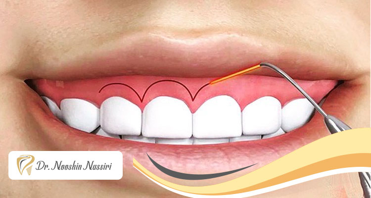 انواع روش‌های افزایش طول تاج دندان