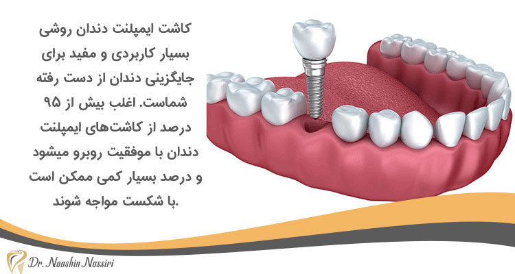 کاشت ایمپلنت دندان روشی برای جایگزینی دندان از دست رفته