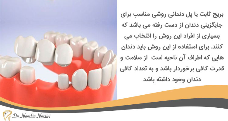بریج ثابت یا پل دندانی روشی برای جایگزینی دندان از دست رفته