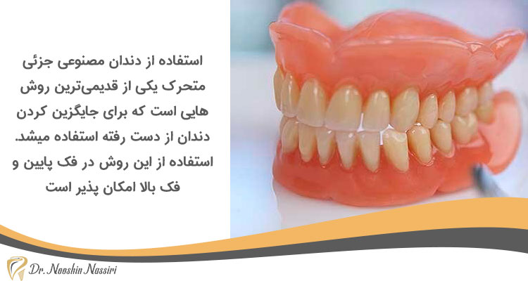دندان‌های مصنوعی جزئی متحرک روشی برای جایگزینی دندان از دست رفته