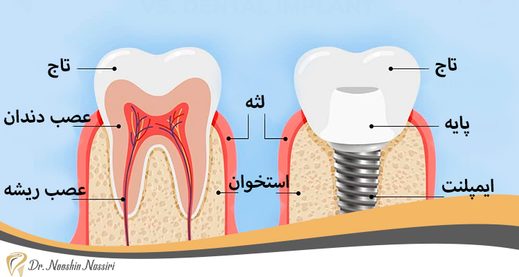 اجزای ایمپلنت دندان