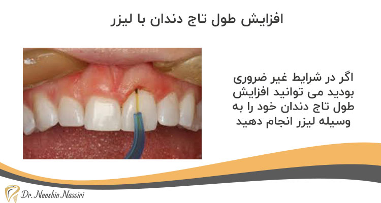 افزایش طول تاج دندان با لیزر