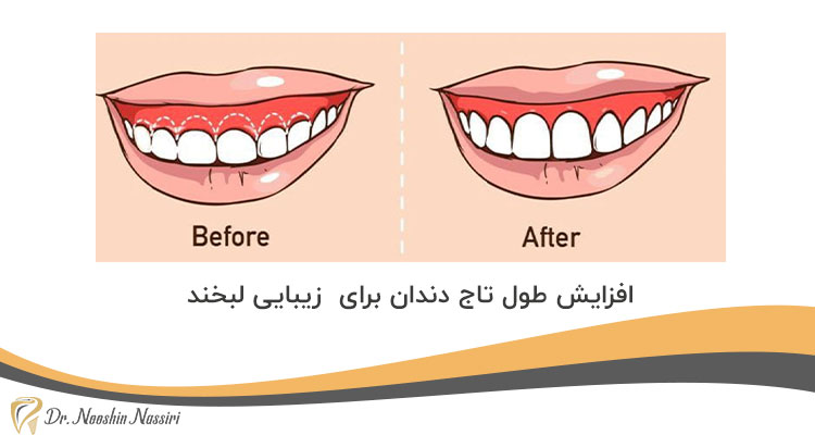 افزایش طول تاج دندان برای زیبایی لبخند