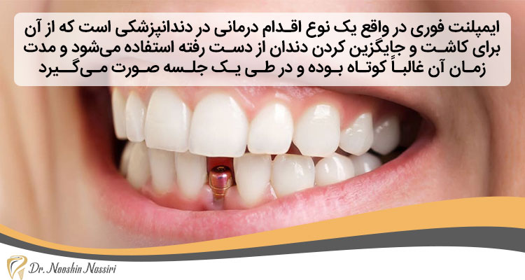 انواع ایمپلنت فوری دندان