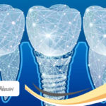 ایمپلنت دیجیتال دندان و مزایای آن