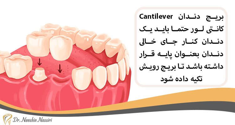 در بریج دندان کانتی لور یک دندان پایه میشود