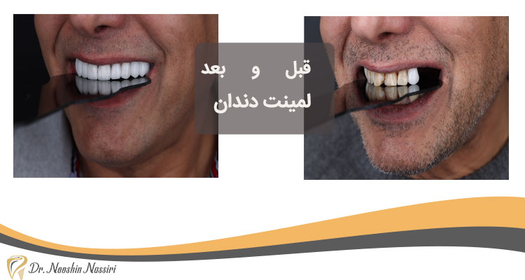 تصویر قبل و بعد لمینت دندان آقایان