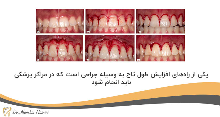 جراحی لثه برای افزایش طول تاج دندان