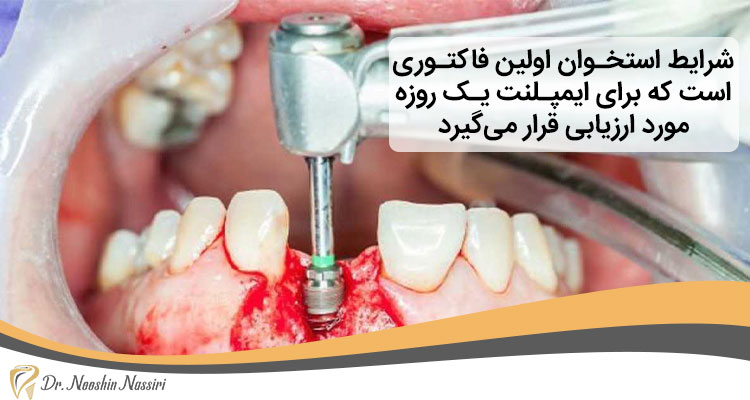 شرایط لازم برای ایمپلنت یک روزه دندان