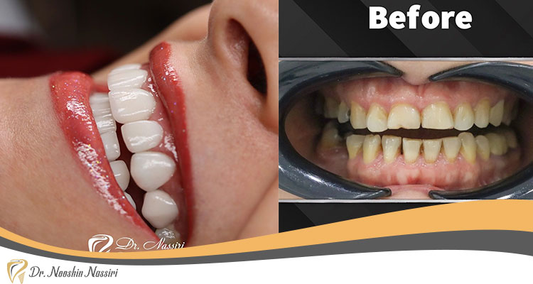 عکس قبل و بعد لمینت سرامیکی دندان در کلینیک دکتر نوشین نصیری