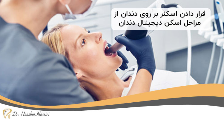قرار دادن اسکنر بر روی دندان از مراحل اسکن دیجیتال دندان