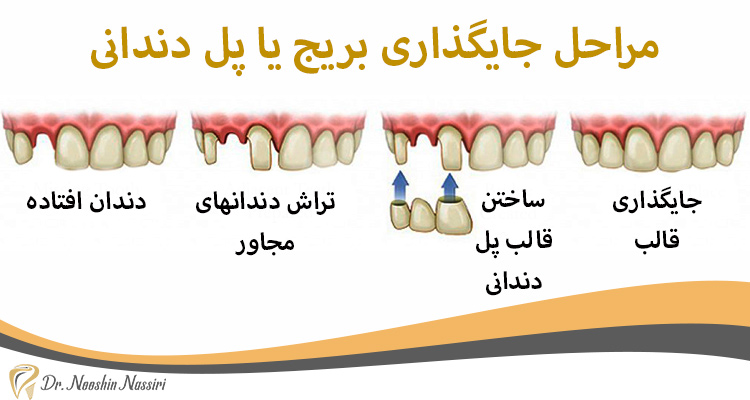 مراحل جایگذاری بریج یا پل دندانی