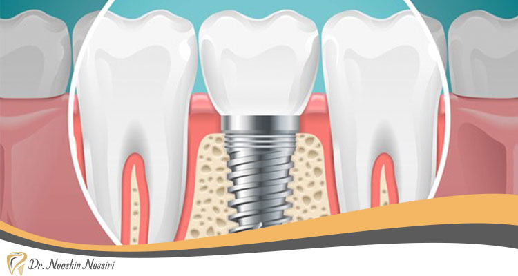 مناسب بودن استخوان از شروط ایمپلنت یک روزه دندان