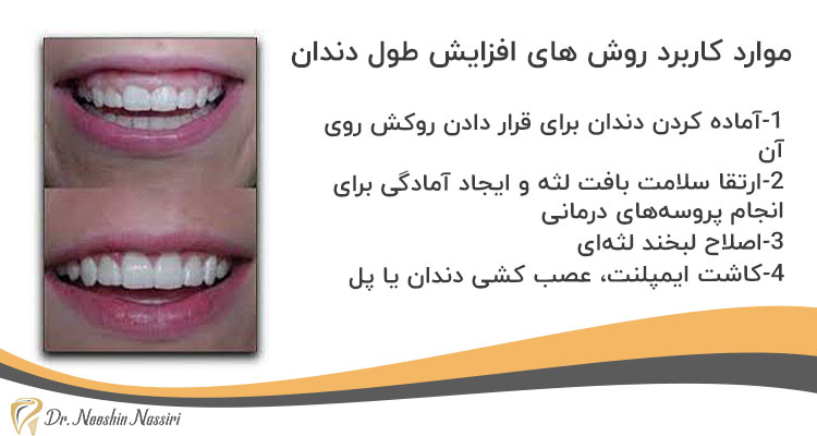 موارد کاربرد روش های افزایش طول دندان