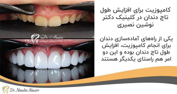 کامپوزیت برای افزایش طول تاج دندان در کلینیک دکتر نوشین نصیری