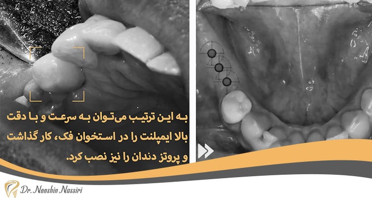قبل و بعد از نصب ایمپلنت دندان دکتر نصیری
