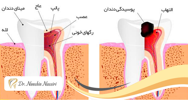 درمان ریشه دندان یا عصب کشی