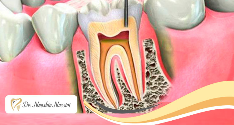 عصب کشی دندان با دستگاه روتاری