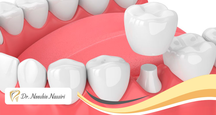 آیا روکش دندان باعث پوسیدگی میشود؟