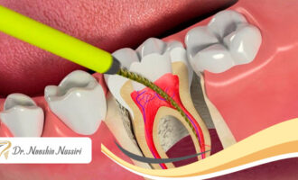 علت درد دندان بعد از عصب کشی