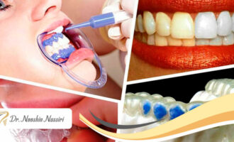 بلیچینگ دندان یا سفید کردن دندان