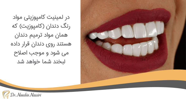 لمینت کامپوزیتی در دندانپزشکی زیبایی در کلینیک دکتر نوشین نصیری