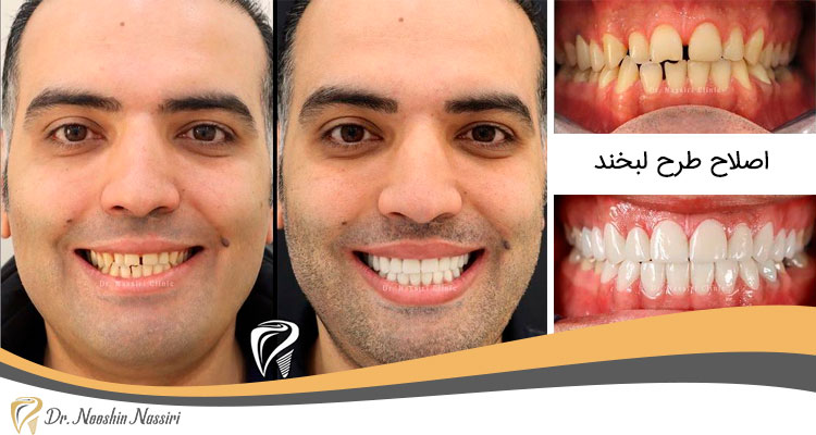 اصلاح رنگ و سایز دندانها و همچنین بستن فواصل بین دندانها با 16 واحد پرسلن لمینیت