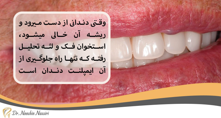 ایمپلنت دندان مانع تحلیل استخوان فک و لثه