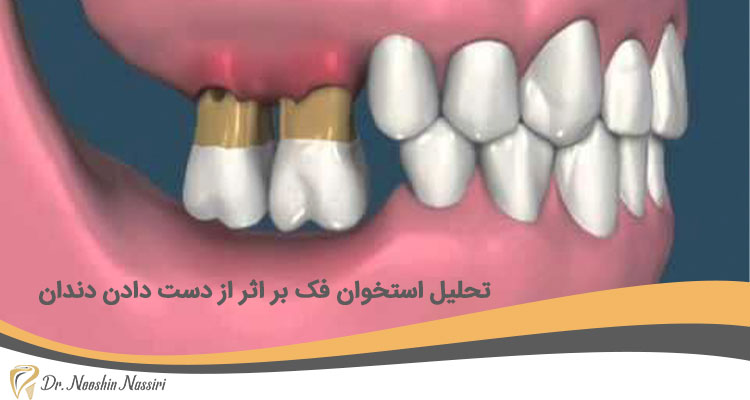 تحلیل استخوان فک بر اثر از دست دادن دندان