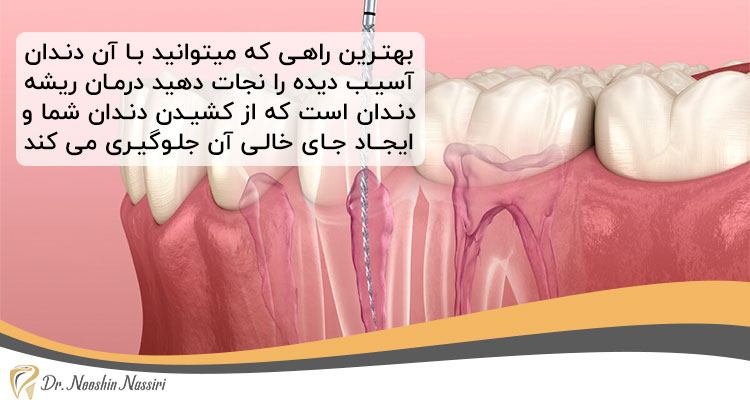 ضرورت درمان ریشه دندان