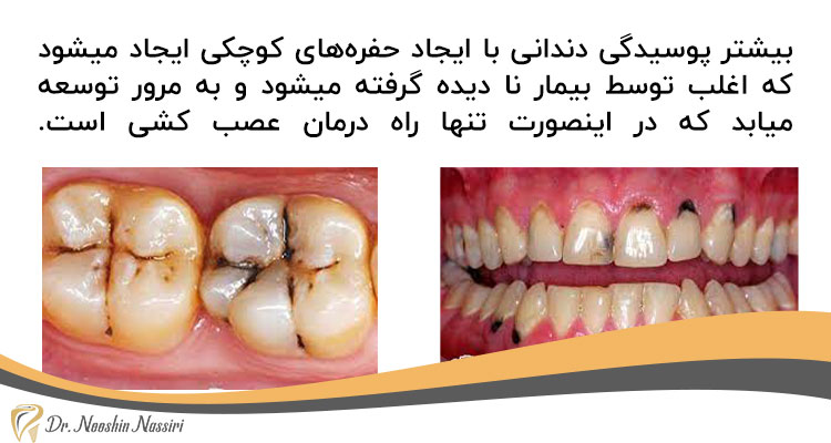 علت درد دندان عصب کشی شده چیست