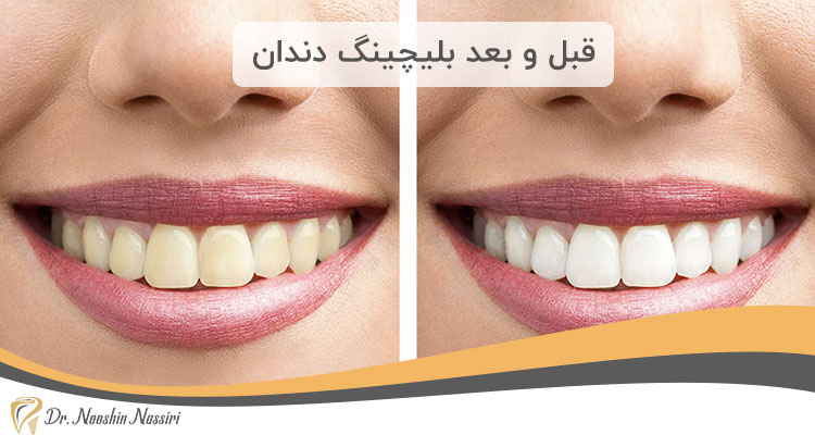 قبل و بعد بلیچینگ دندان