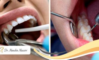 درمان ریشه یا کشیدن دندان