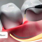 کاربرد لیزر در دندانپزشکی مدرن