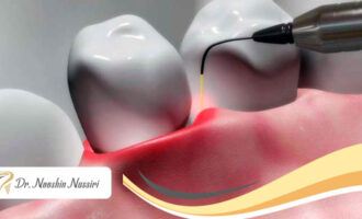 کاربرد لیزر در دندانپزشکی مدرن