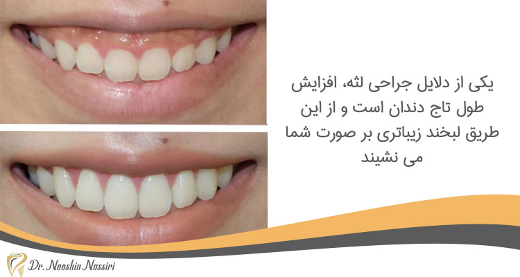 جراحی لثه جهت افزایش طول تاج دندان