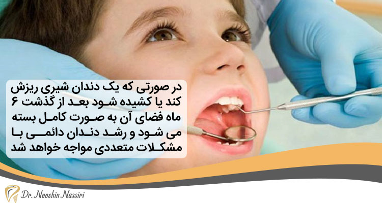 اثر کشیدن یا پوسیدگی دندان شیری بر دندانهای دائمی