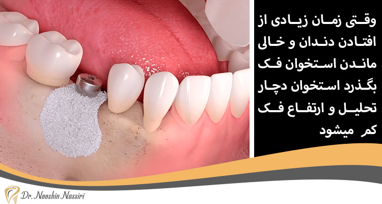 پیوند استخوان برای تحلیل استخوان فک