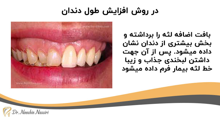 جراحی زیبایی لثه با افزایش طول تاج دندان بیمار