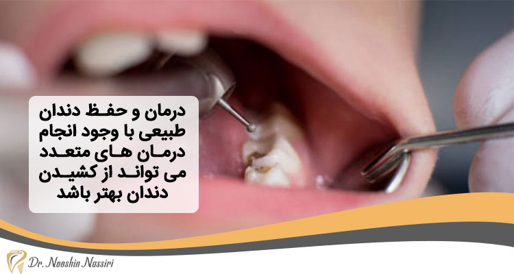 حفظ دندان طبیعی با عصب کشی