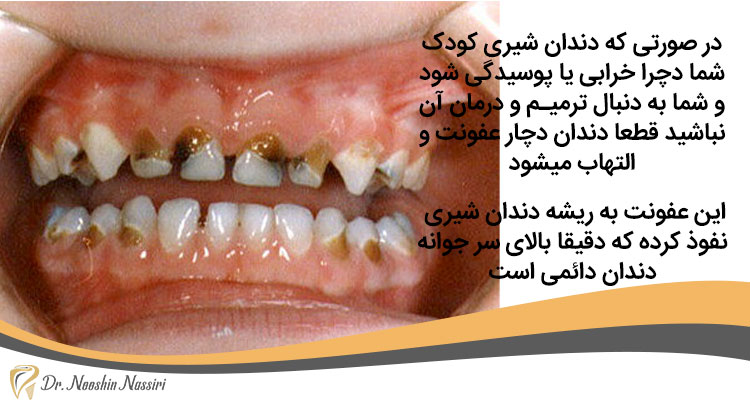 پوسیدگی دندان شیری و رویش دندان های دائمی