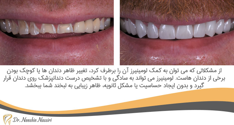 برطرف کردن مشکلات دندانی با لومینیرز دندان
