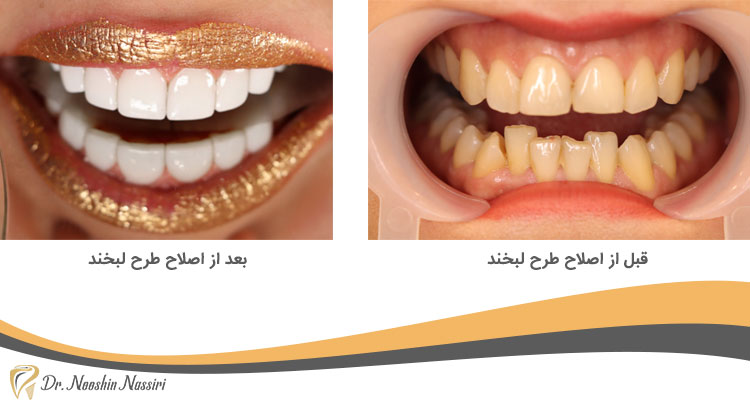 قبل از اصلاح طرح لبخند و بعد از آن در کلینیک دندانپزشکی دیجیتال دکتر نوشین نصیری