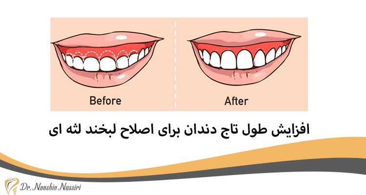 افزایش طول تاج دندان برای اصلاح لبخند لثه ای