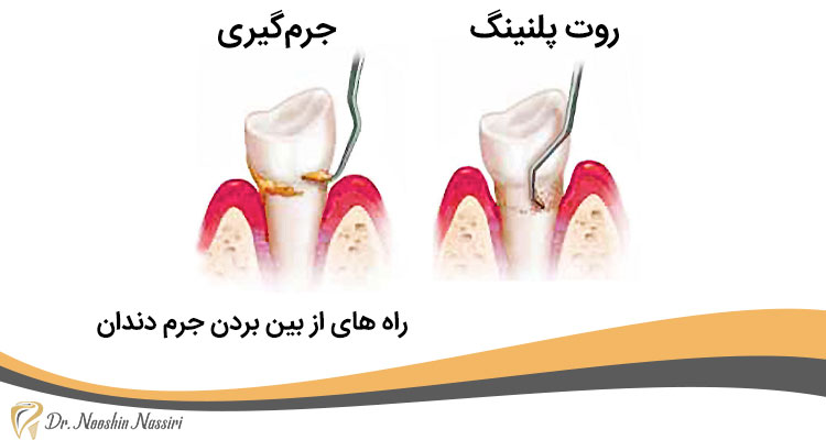 راه های از بین بردن جرم دندان