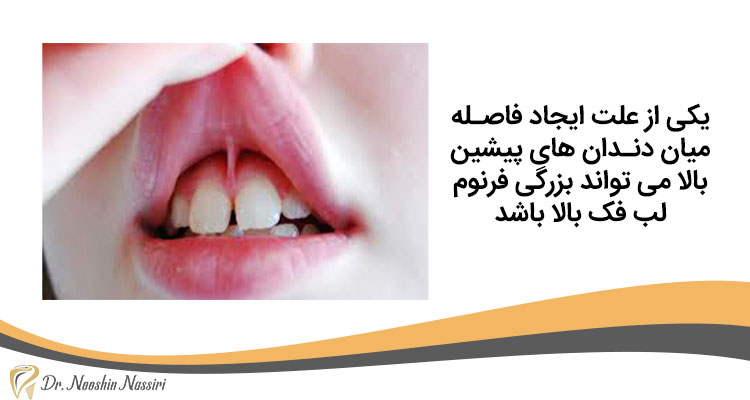 علت ایجاد فاصله میان دندان های پیشین بالا